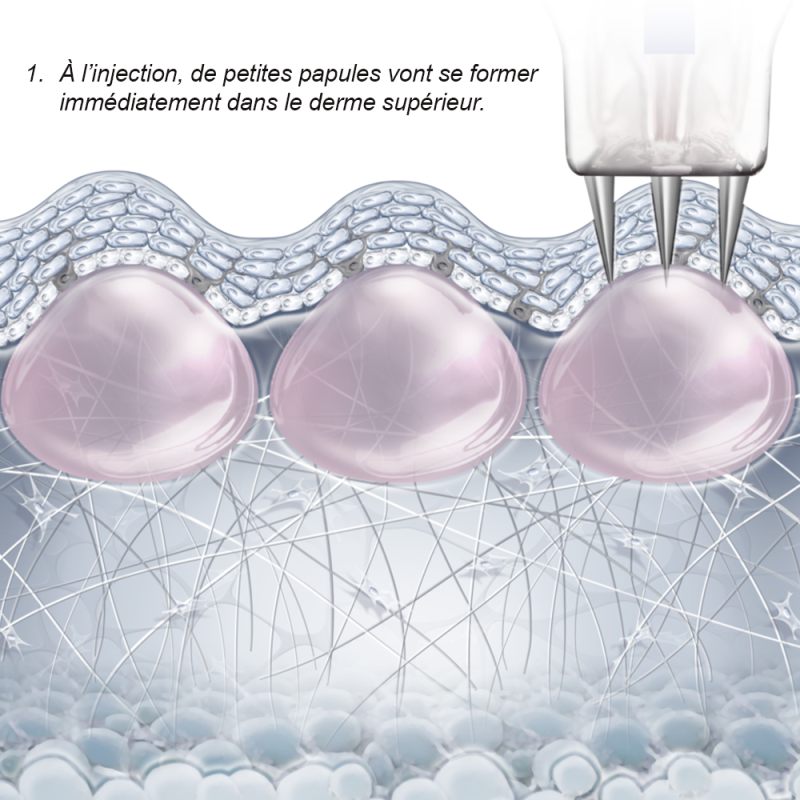 Nanosoft Microneedles par FILLMED - Injection précise et sécurisée